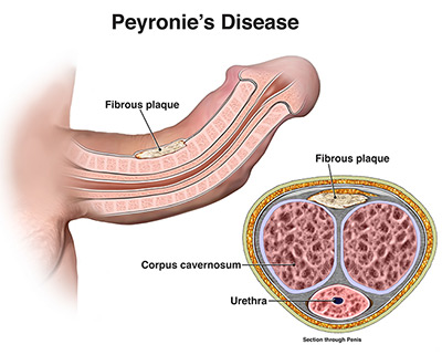 peyronies-bent-penis