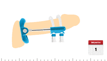 proextender penis enlargement device